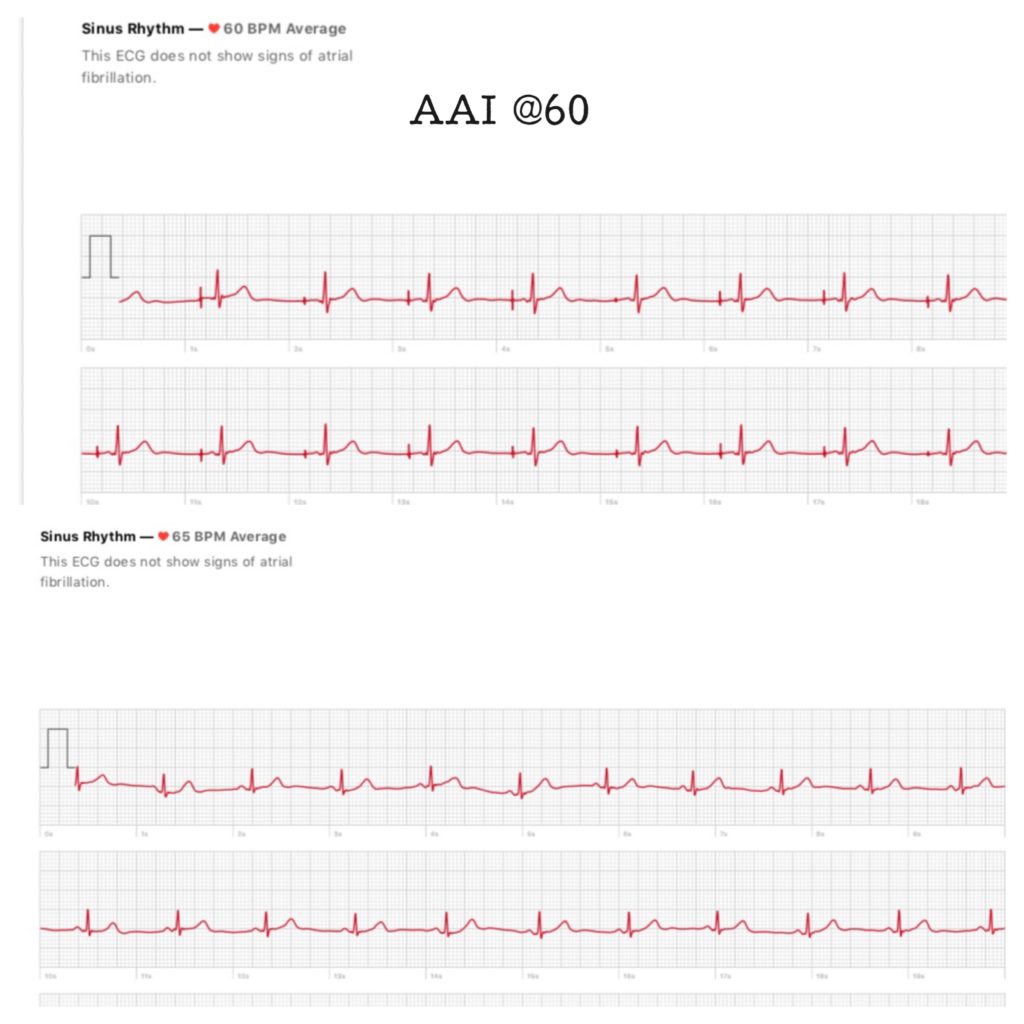 Apple Watch 4 EKG technology | Nurse Katie